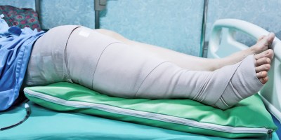 HOW DO WE RECOVER FROM FRACTURES?