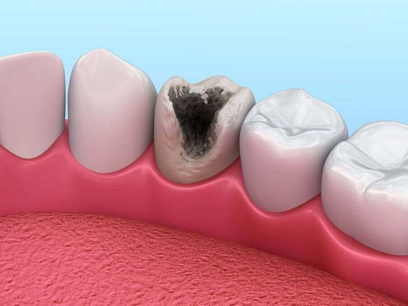 What is Tooth&nbsp;decay?