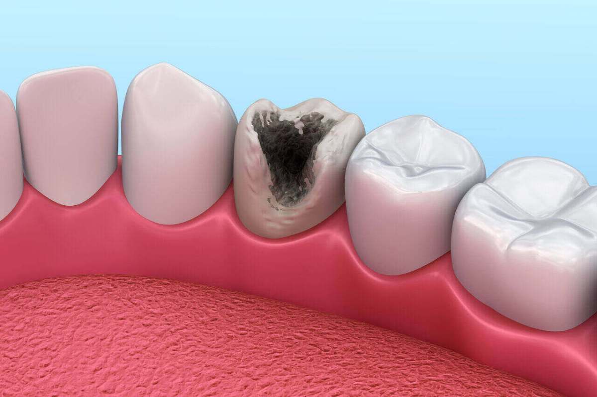 What is Tooth&nbsp;decay?